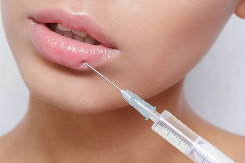 Relleno de labios de ácido hialurónico